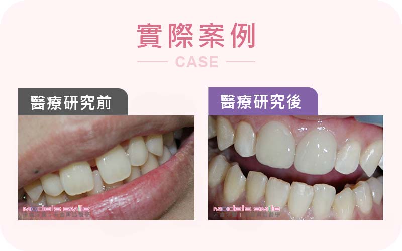 門縫大開?? 漏財? 超薄瓷牙貼片幫你關起你的門牙縫 門縫大開?? 漏財? 超薄瓷牙貼片幫你關起你的門牙縫
