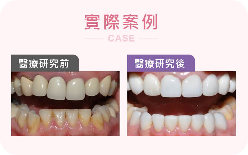 前牙不整齊、牙齒顏色暗黃?帶你打造亮麗自信的微笑! 前牙不整齊、牙齒顏色暗黃?帶你打造亮麗自信的微笑!