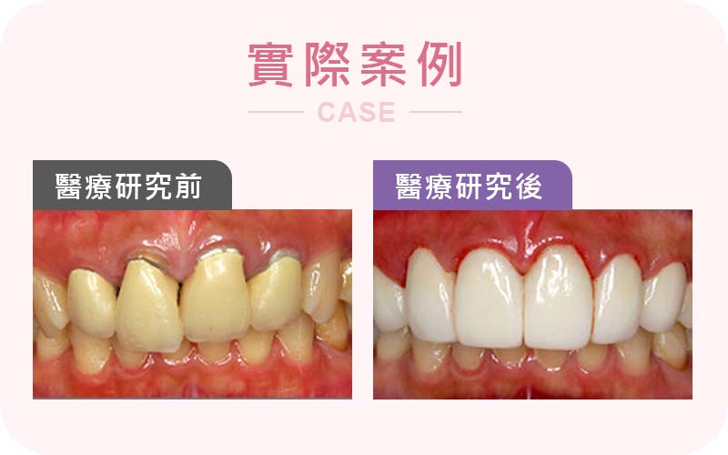 假牙咬合設計不良,進食困難麵條咬不斷 假牙咬合設計不良,進食困難麵條咬不斷