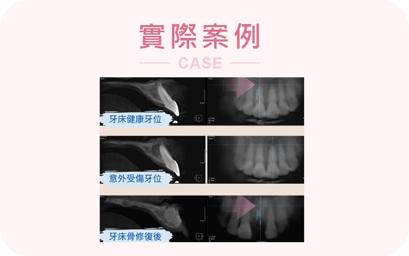 外派工傷 竟然變成大感染?!即刻返國救治