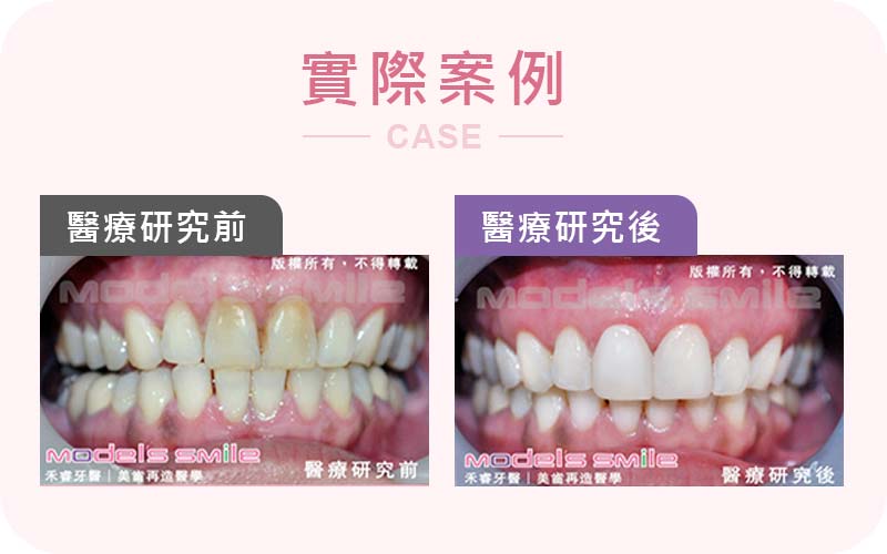 貼片拯救黃牙櫃姐 微笑不再尷尬滿點 貼片拯救黃牙櫃姐 微笑不再尷尬滿點