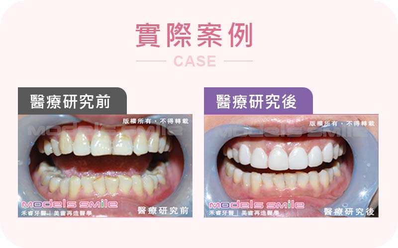 小模優質推薦 貼片美白助鏡頭前展自信 小模優質推薦 貼片美白助鏡頭前展自信